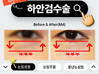 눈밑성형, 나같은 케이스는..