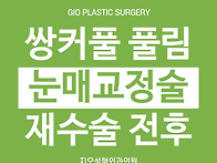 눈매교정수술전후, 쌍커풀..