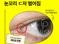뒤트임재건가격 보통 얼마..