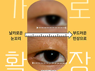 눈커지는수술, 뒤트임 전후..