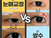 눈매교정 쌍수 차이 정확히..
