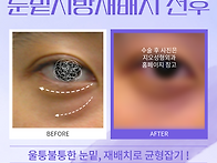 눈밑지 비용 비교전 효과 ..