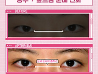 눈커지는법, 쌍수 앞트임으..