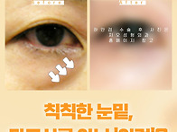 중년 눈성형, 하안검 지방..