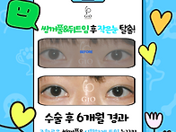 쌍꺼풀 뒤트임 전후사진 ..