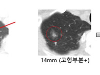 간유리 결절, 10년 지나 ..