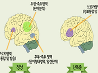 난독증, 단순 언어치료보다..