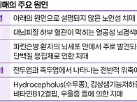 알츠하이머병 치료의 최신..