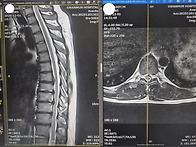 흉추 mri 봐주세요...