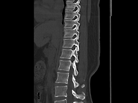 척추CT영상의 일부분입니다..