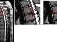 살고싶다 님의 흉추부위 ..
