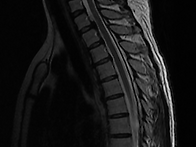 흉추 ,경추,요추 MRI