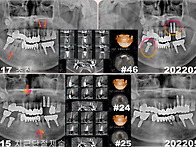 발치즉시식립과 치근단절제..
