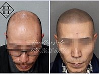 일산두피문신 빠진 모발 ..