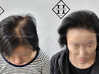 김포두피문신 여성 정수리..