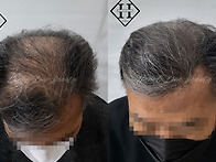 일산두피문신 탈모인들께서..