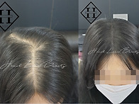 일산두피문신 잘하는곳, ..