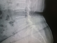 모친허리시술:나은병원(2..