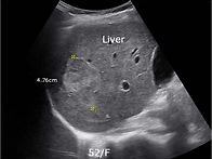 Hepatic hema..