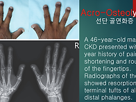 Acro-Osteoly..