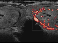 thyroid aden..