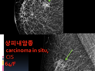 유방_상피내암종(..