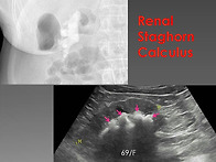 Renal Stagho..