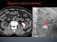 Staghorn cal..