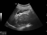 R/O retroperitonea..