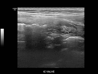 R/O appendicitis