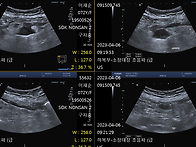 충수돌기 천공 복막염