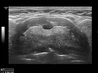 Thyroglossal duct ..