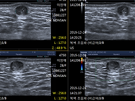 Epidermoid cyst