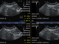 r/o epiploic appen..