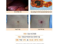 담낭선근종증수술후기. 단..