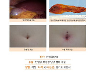 만성담낭염수술후기. 수술..