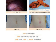 담낭선근종증수술후기. 1..