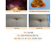 담낭용종수술후기. 긴장된..