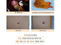 담낭선근종증수술후기. 튼..