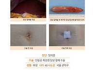 담석증수술후기. 김정윤 ..