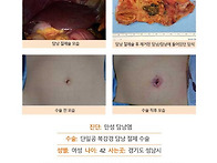 만성담낭염수술후기. 수술..