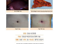 담낭선근종증수술후기. 오..