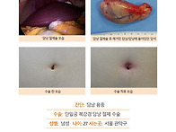 담낭용종수술후기. 전신마..