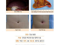 담낭용종수술후기. 소화불..