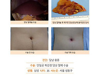 담낭용종수술후기. 매년 ..