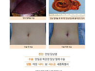 만성담낭염수술후기. 김정..