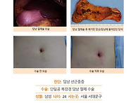 담낭선근종증수술후기. 수..
