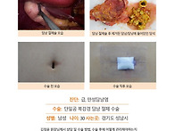 급만성담낭염수술후기. 김..