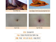 담낭슬러지수술후기. 처음..