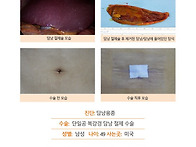 담낭용종수술후기. 만 50..